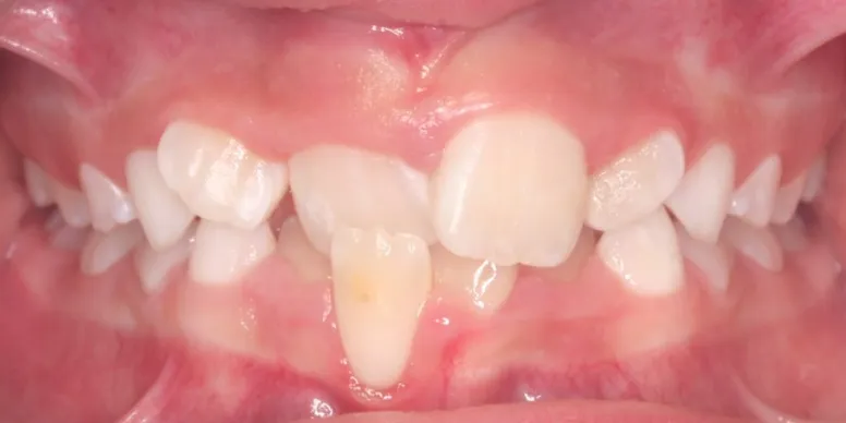 Photo of anterior crossbite, where an upper front tooth is locked behind the bottom one