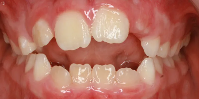 Photo showing open bite - large gap between top and bottom front teeth