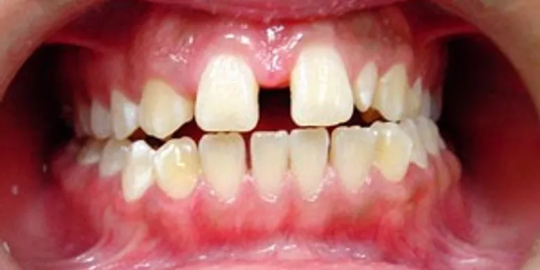 Photo showing diastema - large space between front teeth