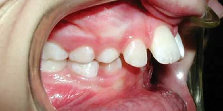 Photo showing large overjet - top teeth sticking out much further than bottom teeth