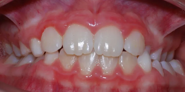 Photo of posterior crossbite, where back teeth are not aligned properly