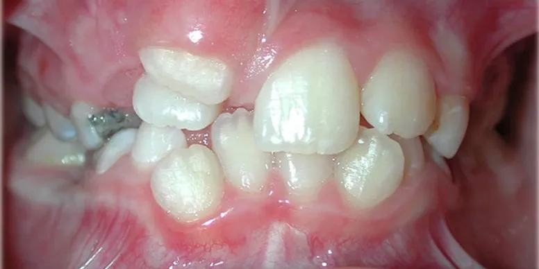 Photo showing severe crowding and overlapping of teeth