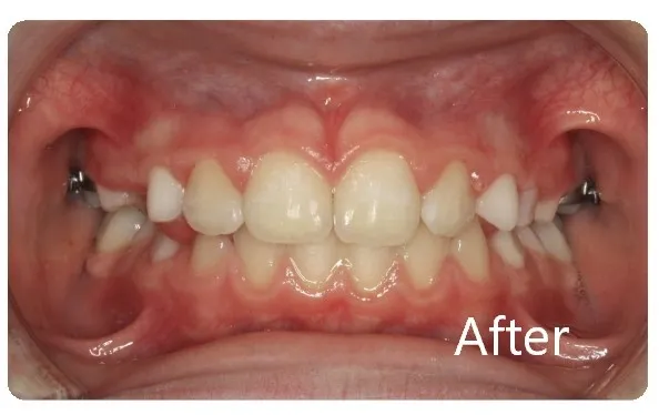 Photo showing after phase I treatment with teeth aligned and arch widened