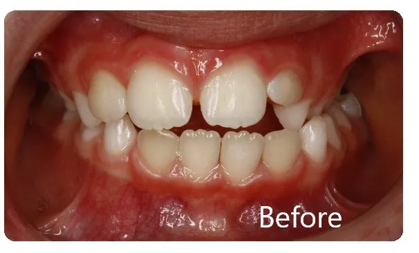 Photo showing before phase I treatment, with teeth crowded and narrowed arch