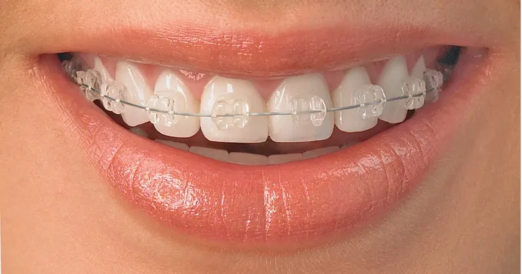 Close up photo of a smile with clear braces
