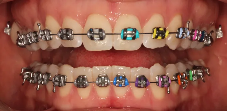 Close up photo of teeth with metal braces on, with various colored bands